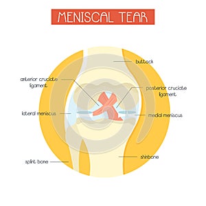 Vector illustration of meniscal tear of knee joint photo