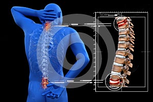 Anatomical vision back pain. Spine anatomy. 3D illustration