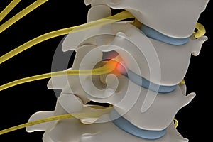 Anatomically accurate3d image of cervical spine with prolapse of