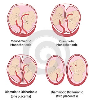 Anatomy of abdomen with twins. Twin types infographic elements in flat design