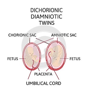 Anatomy of abdomen with twins. Twin types infographic elements in flat design. Monozygotic or Dizygotic Placentation of twins