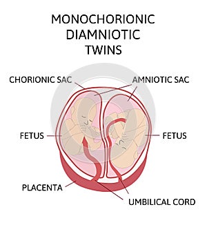 Anatomy of abdomen with twins. Twin types infographic elements in flat design. Monozygotic or Dizygotic Placentation of twins