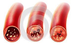 Anatomy of Atherosclerosis in artery