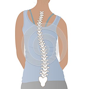 Anatomy of curvature of the spine in scoliosis.