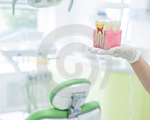 Anatomy of a dental model concept of a dentist cross section for education. The dentist holds a mock tooth in section in