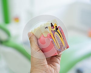 Anatomy of a dental model concept of a dentist cross section for education. The dentist holds a mock tooth in section in