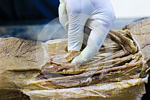 Anatomy dissection of a cadaver showing adductor canal using scalpel scissors and forceps cutting skin flap revealing important st