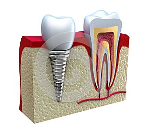 Z zdravé zuby a zubný implantát 