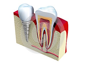 Z zdravé zuby a zubný implantát v čeľusť 