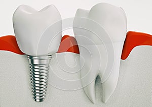 Anatomy of healthy teeth and dental implant in jaw bone - 3d rendering