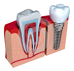Z zdravé zuby a zubní implantát v čelistní kosti 