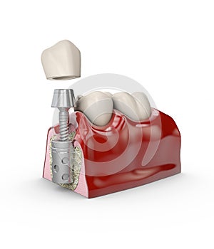 Anatomy of healthy teeth and dental implant in jaw bone. Stomatology concept 3d illustration.