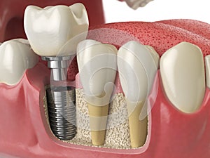 Anatomy of healthy teeth and tooth dental implant in human denturra. photo