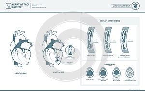 Anatomy of a heart attack