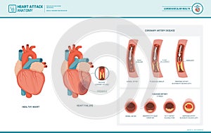 Anatomy of a heart attack