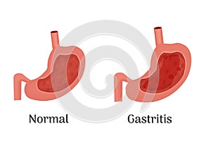 Anatomy of the human healthy and unhealthy stomach, medical poster with a detailed diagram of the structure from the