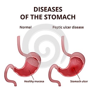 Anatomy of the human healthy and unhealthy stomach
