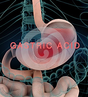 Anatomy illustration of gastric acid or heartburn, inflamed red stomach showing acid in red.