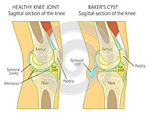 Anatomy of the knee_Baker`s cyst