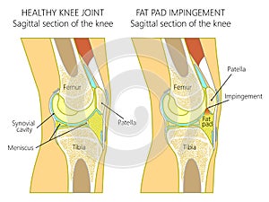 Anatomy of the knee_Fat pad impingement due to hyperextension