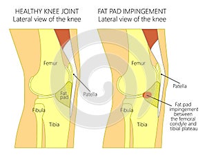 Anatomy of the knee_Fat pad impingement syndrome