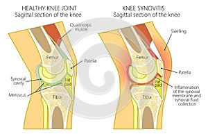 Anatomy of the knee_synovitis photo