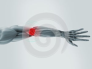 Anatomy model showing elbow pain.