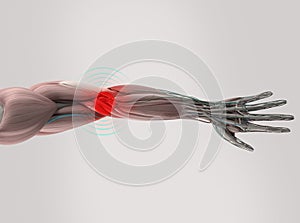 Anatomy model showing elbow pain.