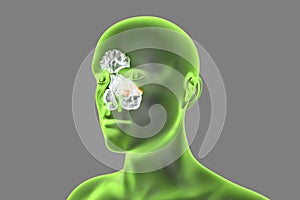 Anatomy of paranasal sinuses photo