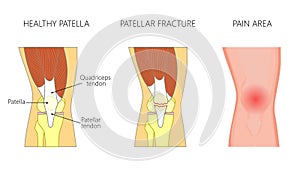 Anatomy_Patellar fracture