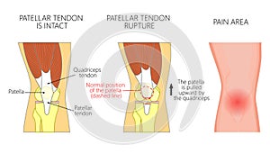 Anatomy_Patellar tendon rupture