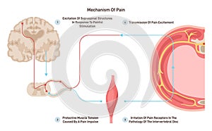 Anatomy and physiology of pain. CNS reaction or reflex on painfull photo