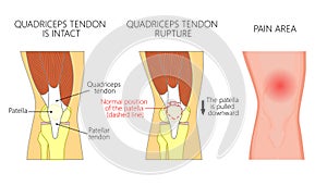Anatomy_Quadriceps tendon rupture photo