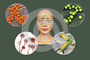 Anatomy of rhinosinusitis and microorganisms that cause sinusitis