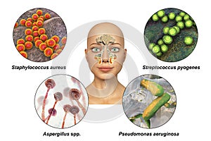 Anatomy of rhinosinusitis and microorganisms that cause sinusitis