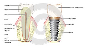 Anatomy of a tooth and dental implant