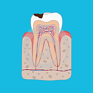 Anatomy of Unhealthy tooth with tooth decay isolated cross section. Medical dental poster illustration in flat design.