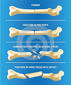 Anatomy various skeletal bone fractures
