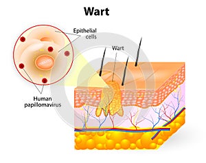Anatomy of Wart photo