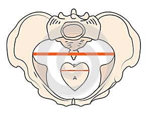Android Pelvis Shape w Triangular / Heart shape