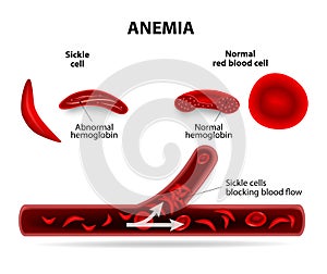 Anemia