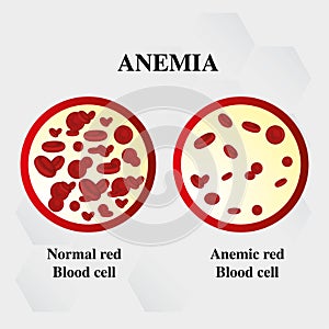 Anemia amount of red blood Iron deficiency anemia difference of Anemia amount of red blood cell and normal symptoms vector illustr