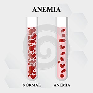 Anemia amount of red blood Iron deficiency anemia difference of Anemia amount of red blood cell and normal symptoms vector illustr