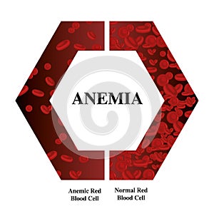 Anemia amount of red blood Iron deficiency anemia difference of Anemia amount of red blood cell and normal symptoms vector illustr