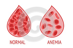 Anemia. Comparison of a drop of blood with normal and anemic blood cells photo