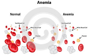 Anemia Diagram photo
