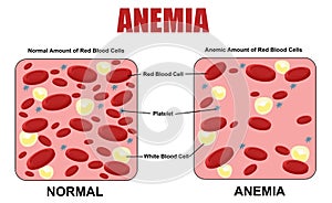 Anemia diagram photo