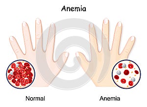 Anemia. hand of healthy human and anaemia
