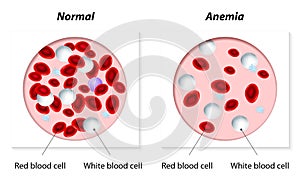 Anemia photo