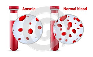 Anemia problem circulatory iron body diagram background. Anaemia biology blood isolated medical normal icon.